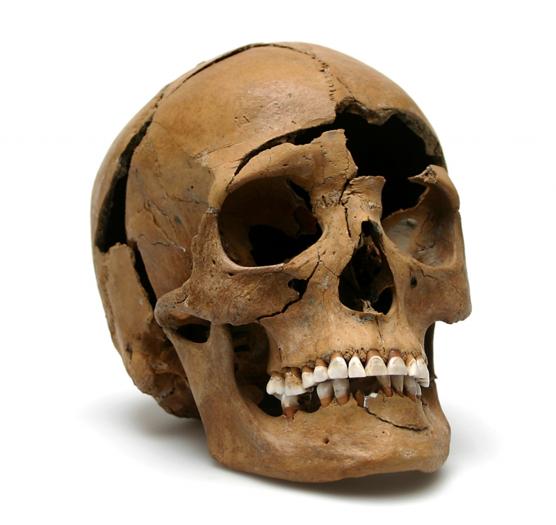 Figure 6: Regensburg-Harting, skull with deadly blow on the forehead from a well in the villa rustica.